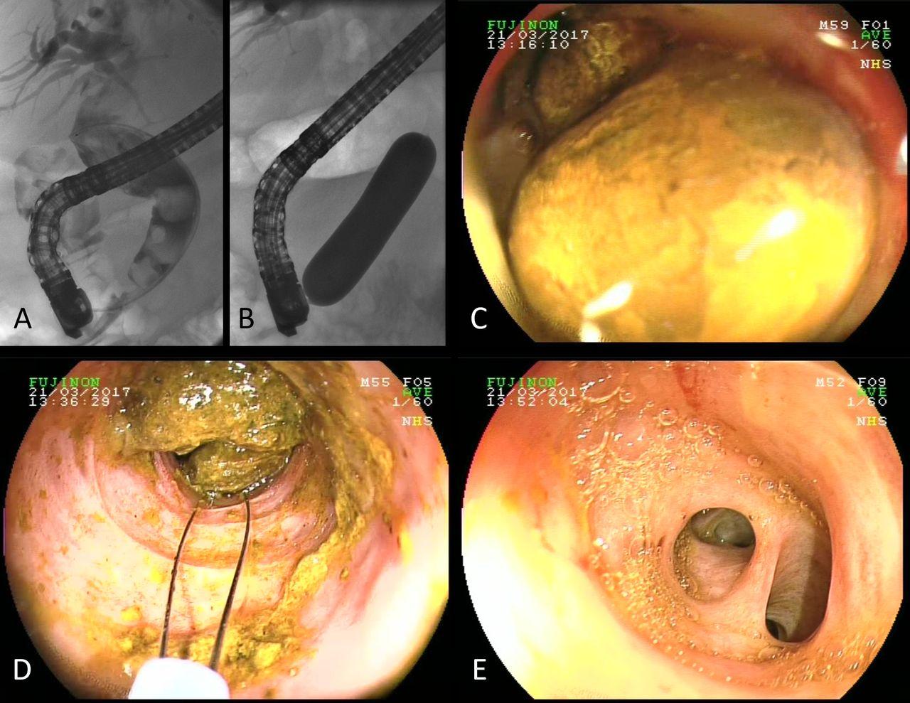 Using the Gallbladder Divergent Channel to Calm an Irritated Vagus Nerve