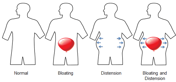 Abdominal Bloating And Distension