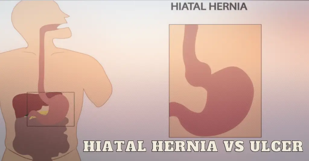 Hiatal Hernia vs Ulcer