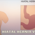 Hiatal Hernia vs Ulcer